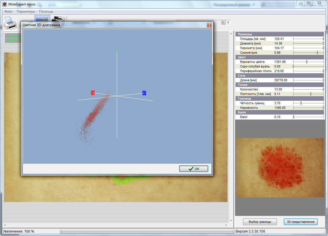 MoleExpert micro: 3D-диаграмма распределения пигментации